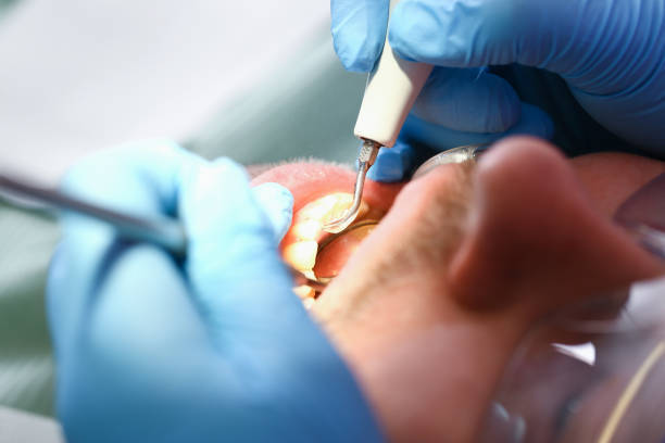 Best Emergency Gum Treatment in West Chester, PA
